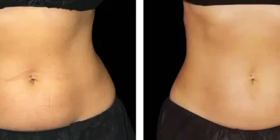 imgi_2_emsculpt-neo-results-new-jersey-1