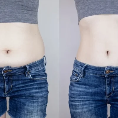 imgi_2_fat-reduction-1