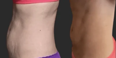 imgi_3_Does-Emsculpt-Work-1024x660