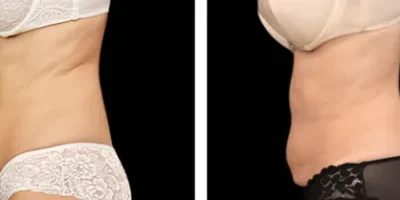 imgi_3_Emsculpt-Benefits-1