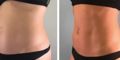 imgi_3_Emsculpt-Results