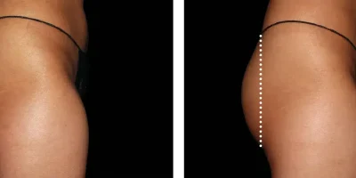 imgi_3_emsculpt-neo-near-me-oradell-nj